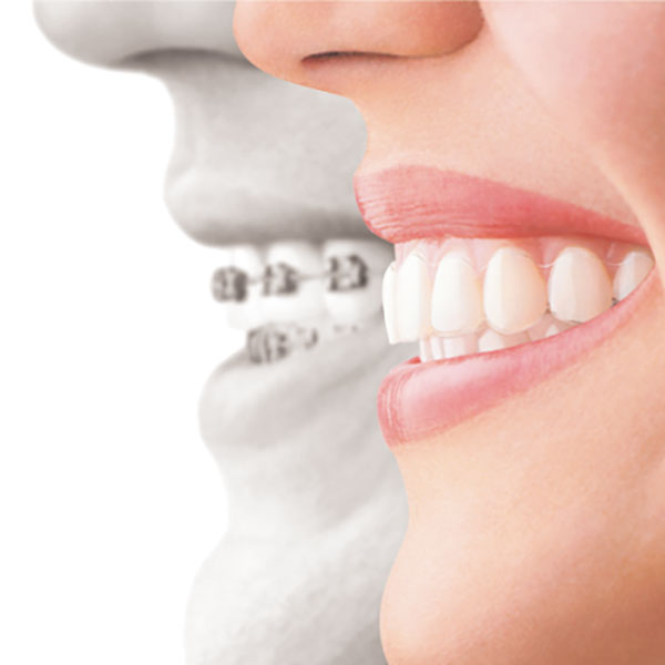 矯正治療イメージ